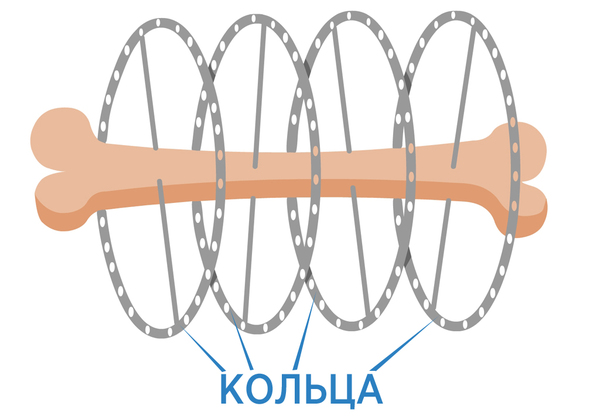 Аппарат Илизарова