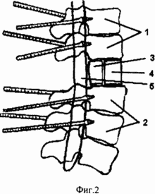 СПОСОБ ХИРУРГИЧЕСКОГО ЛЕЧЕНИЯ ПОСЛЕДСТВИЙ ПЕРЕЛОМОВ ПОЗВОНОЧНИКА